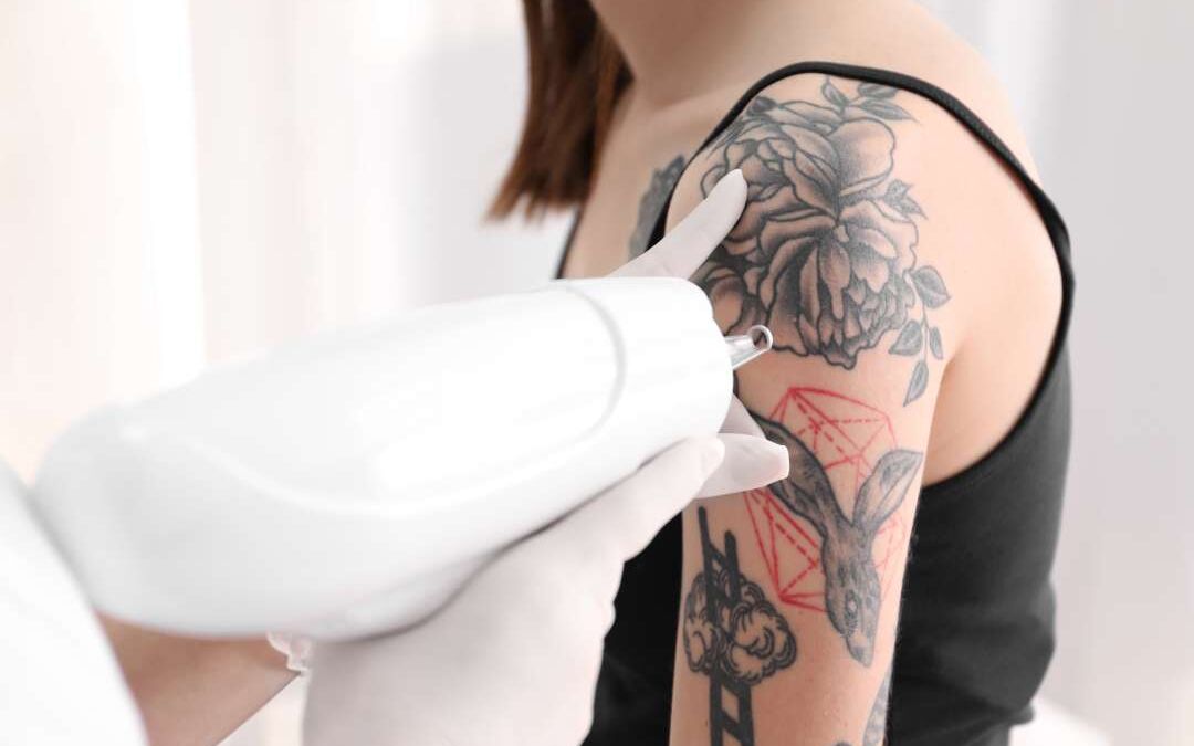 How Safe Is Tattoo Removal? What to Expect During the Process
