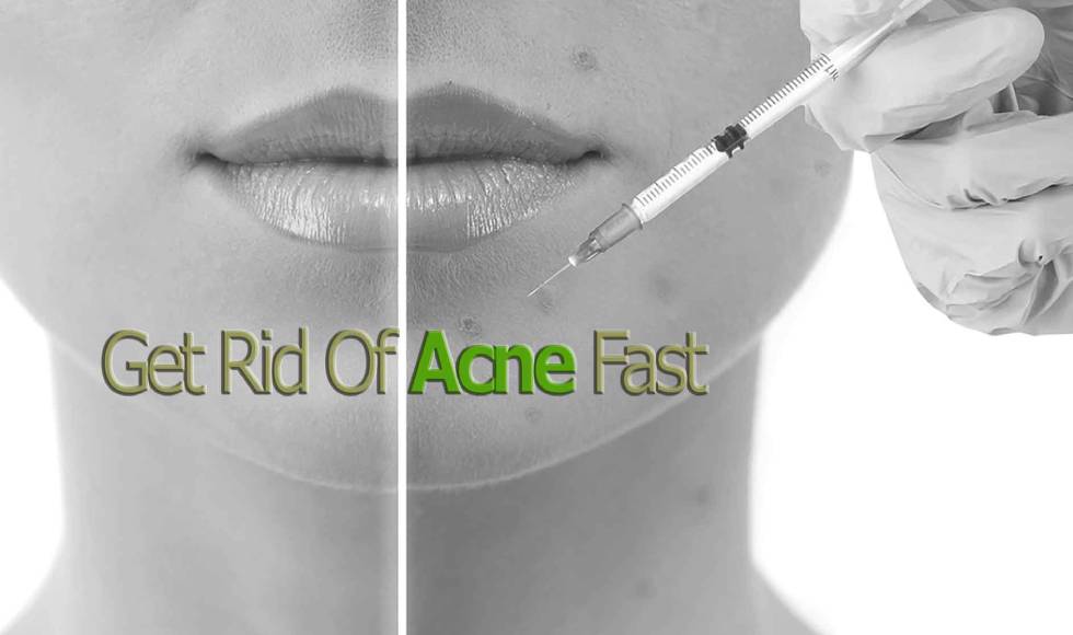 Cortisone Shot Acne Injections Banner