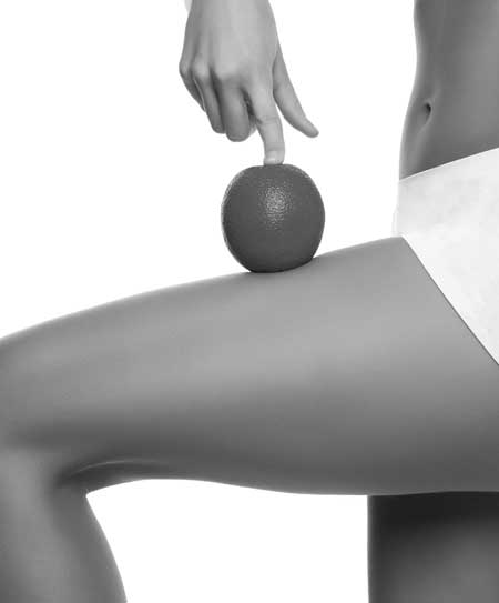 Laser Stretch Mark Treatment Toronto