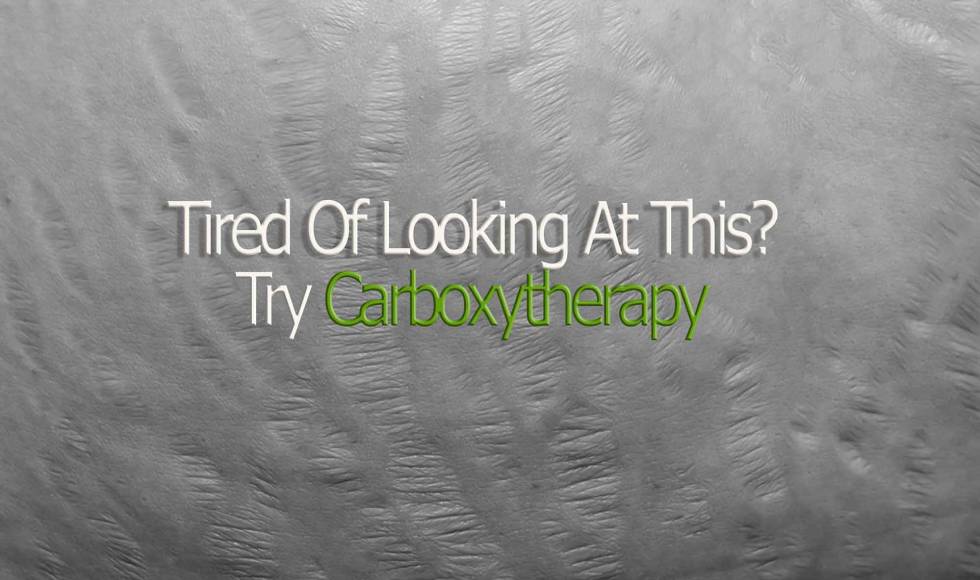 carboxytherapy stretch mark treatment Toronto Banner