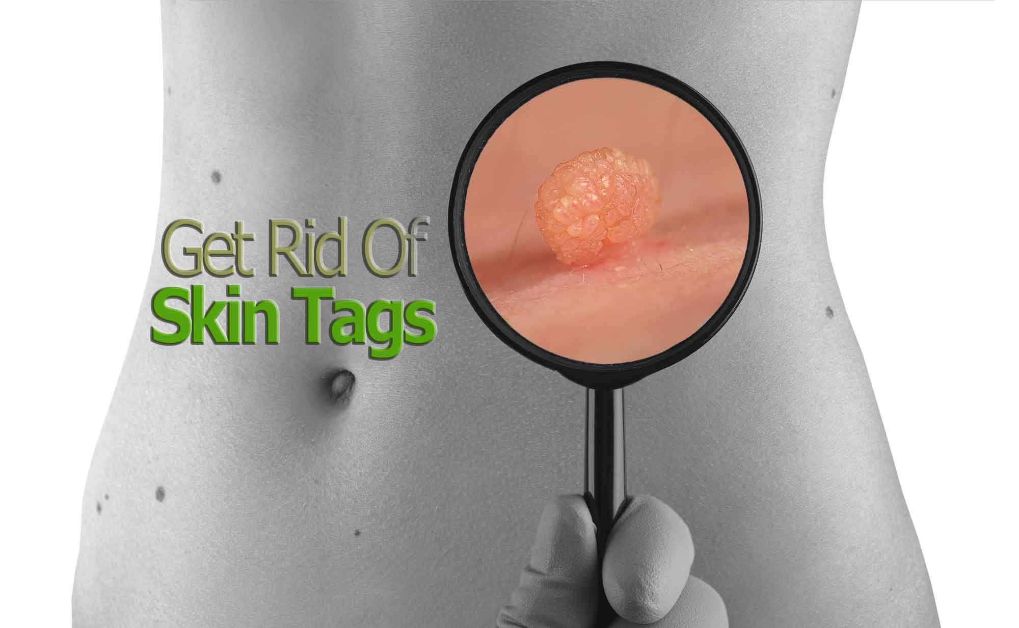 Skin Tag Removal Treatment & Laser Mole removal Treatment in Toronto Banner