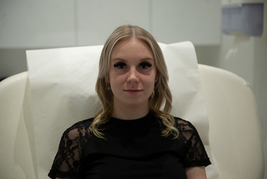 Facial Dermal Fillers Treatment Before Toronto Mobile