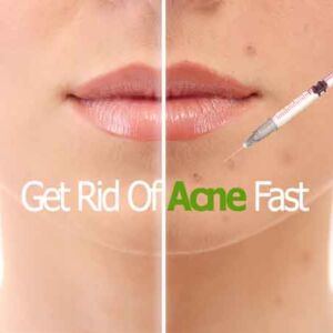 Acne Injection