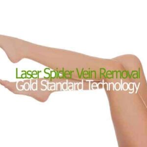 Spider Vein Removal Large Area