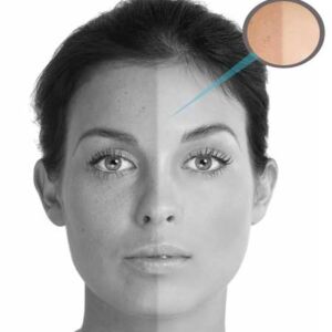 Picosure Pigment Hands pkgs