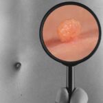 Toronto Large Skin Tag Removal Product Image