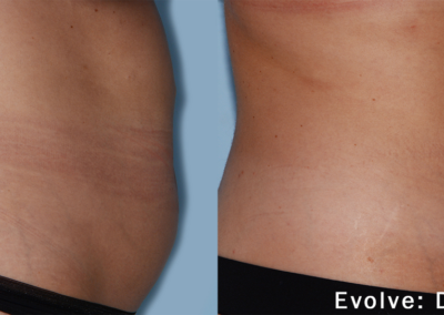 Evolve Before After 2