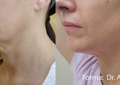 Forma Before After 1