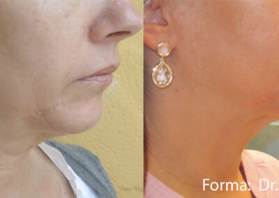 Forma Before After 2