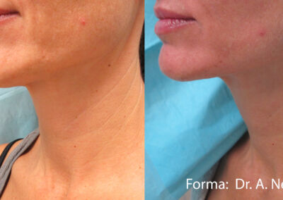 Forma Before After 3