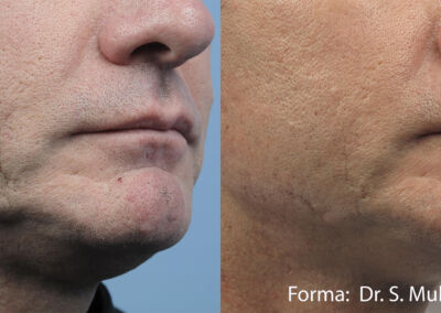 Forma Before After 4