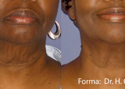 Forma Before After 5