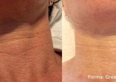 Forma Before After 6