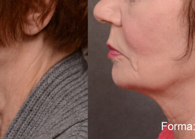 Forma Before After 7