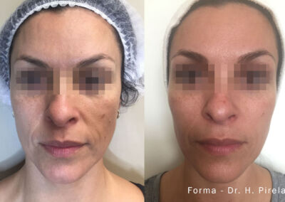 Forma Before After 8