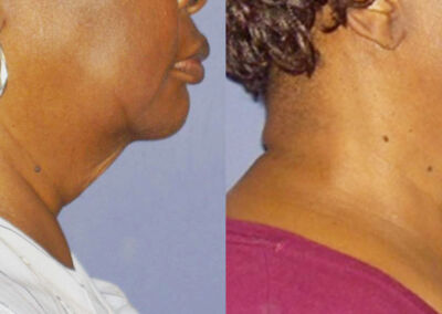 Forma Before After 9