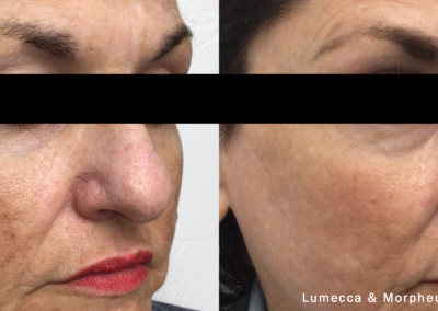 Morpheus Before After 2