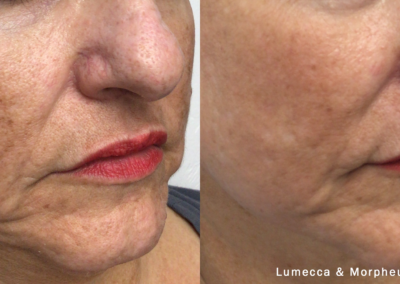 Morpheus Before After 1