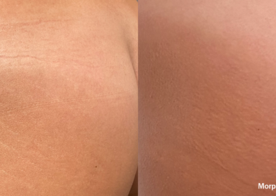 Morpheus Before After 3