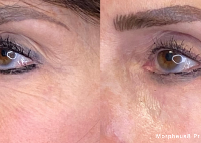 Morpheus Before After 4