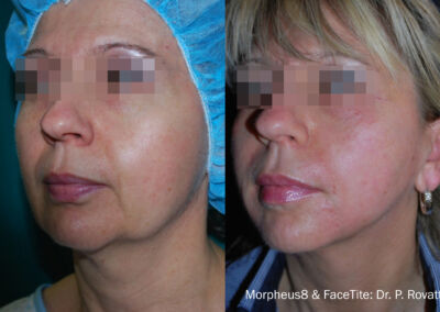 Morpheus Before After 16