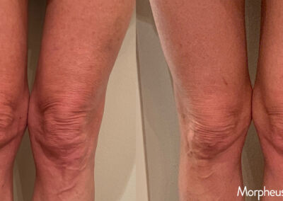 Morpheus Before After 17