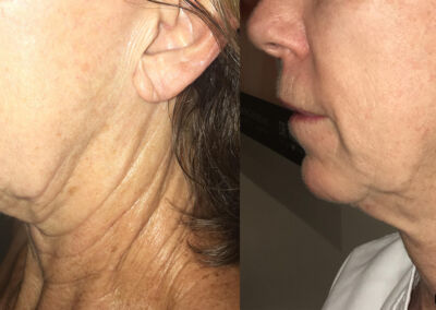 Morpheus Before After 8