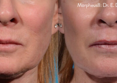 Morpheus Before After 9