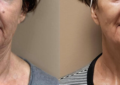 Morpheus Before After 10