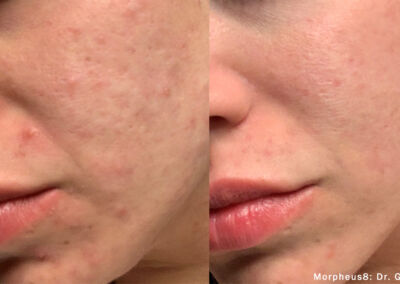 Morpheus Before After 6