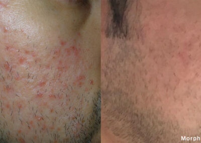 Morpheus Before After 13