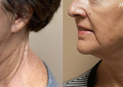 Morpheus Before After 15