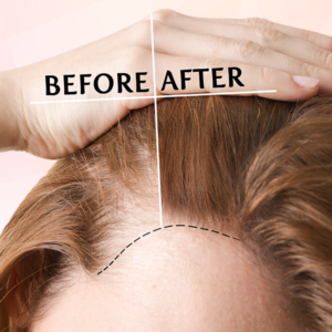 Laser Hair Rejuvenation