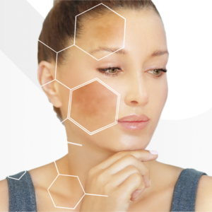 Photorejuvenation IPL Neck