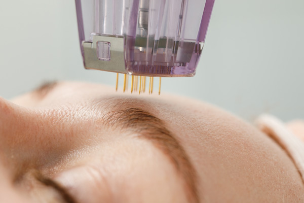 How Often Should You Get Microneedling Treatments for Best Results?