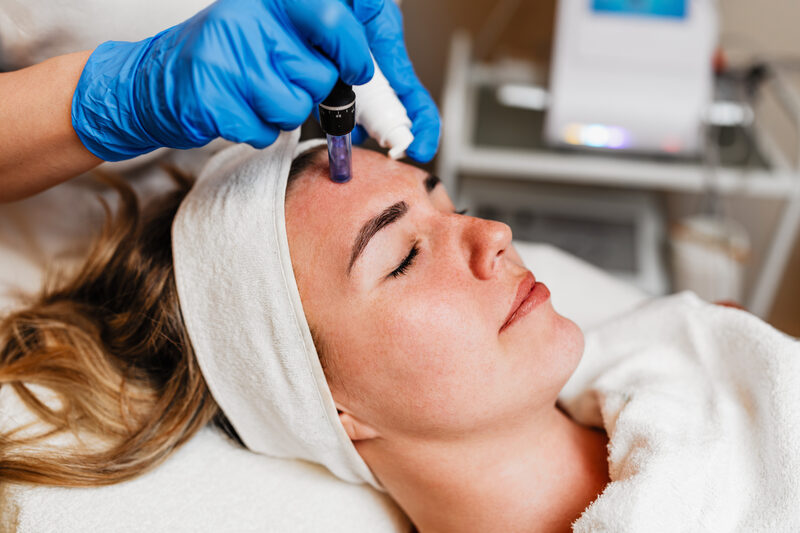 Microneedling vs. Chemical Peels: Which One Is Better?