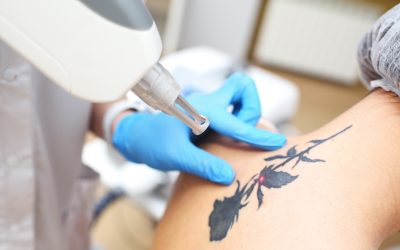 Tattoo Removal Myths You Should Stop Believing